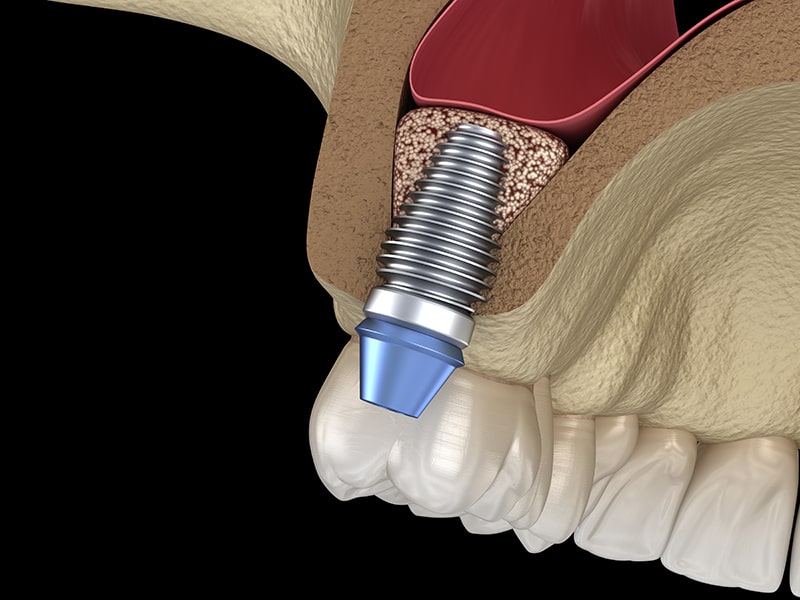 Illustration of result of bone graft procedure result with dental implant