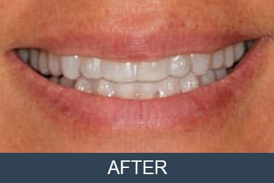 After Invisalign Teeth Straightening
