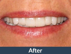 A patient with porcelain veneers from Kuhn Dental.