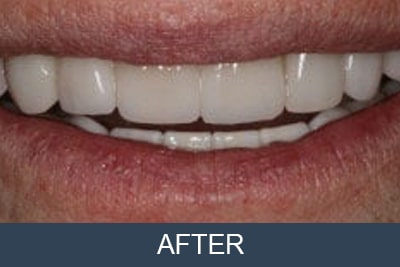 Patient after cosmetic crowns at Kuhn Dentist