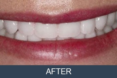 Patient after full implant supported restorations