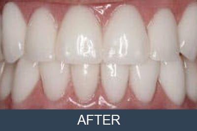 Patient after implant supported dentures