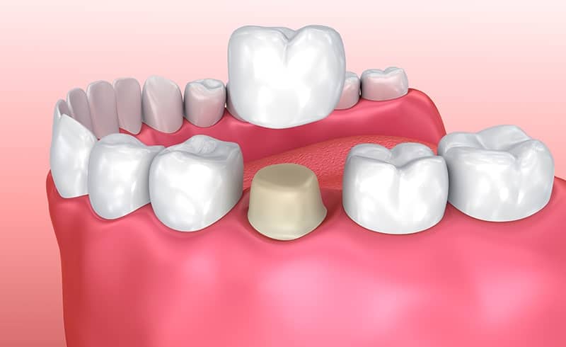 Dental crown placement illustration for restorative dentistry