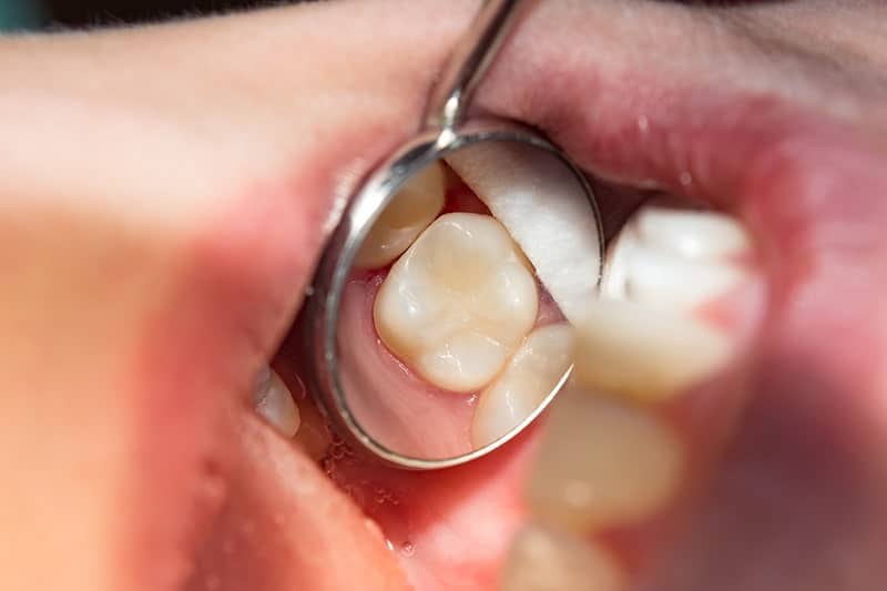 Dentist using mirror to examine tooth and prepare for restorative dentistry