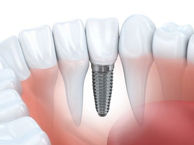 Dental implant placement illustration