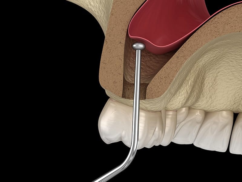 Image diagram of a bone graft procedure