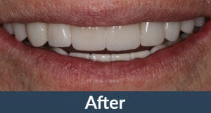 A patient with dental crowns from Kuhn Dental.