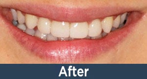 A patient with porcelain veneers from Kuhn Dental.