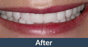 A patient with implant supported dentures from Kuhn Dental.
