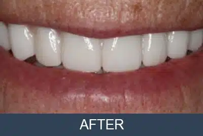 Patient after full mouth restorations