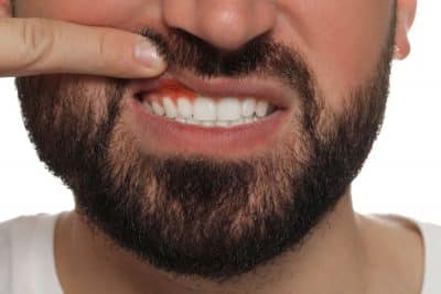 upclose of man with inflamed gums
