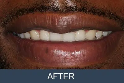 Straighten crooked teeth with orthodontics