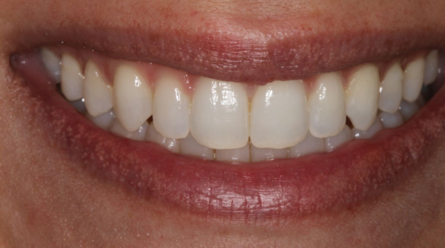 A close-up of a smile showing clean, straight, white teeth framed by natural-colored lips.