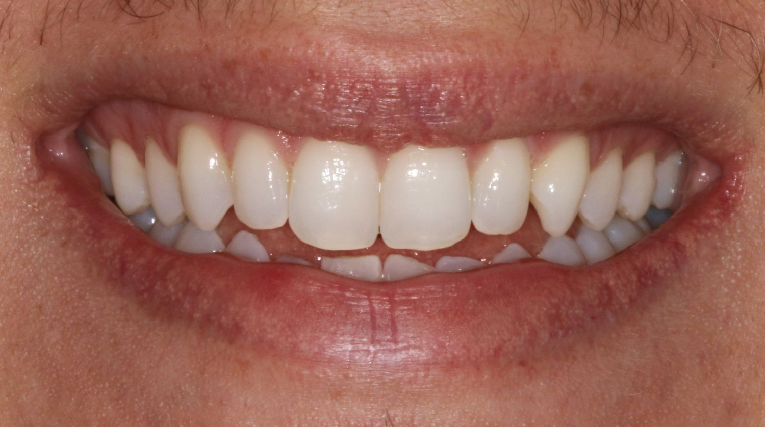 A close-up of a smile with straight, white teeth and natural-colored lips.