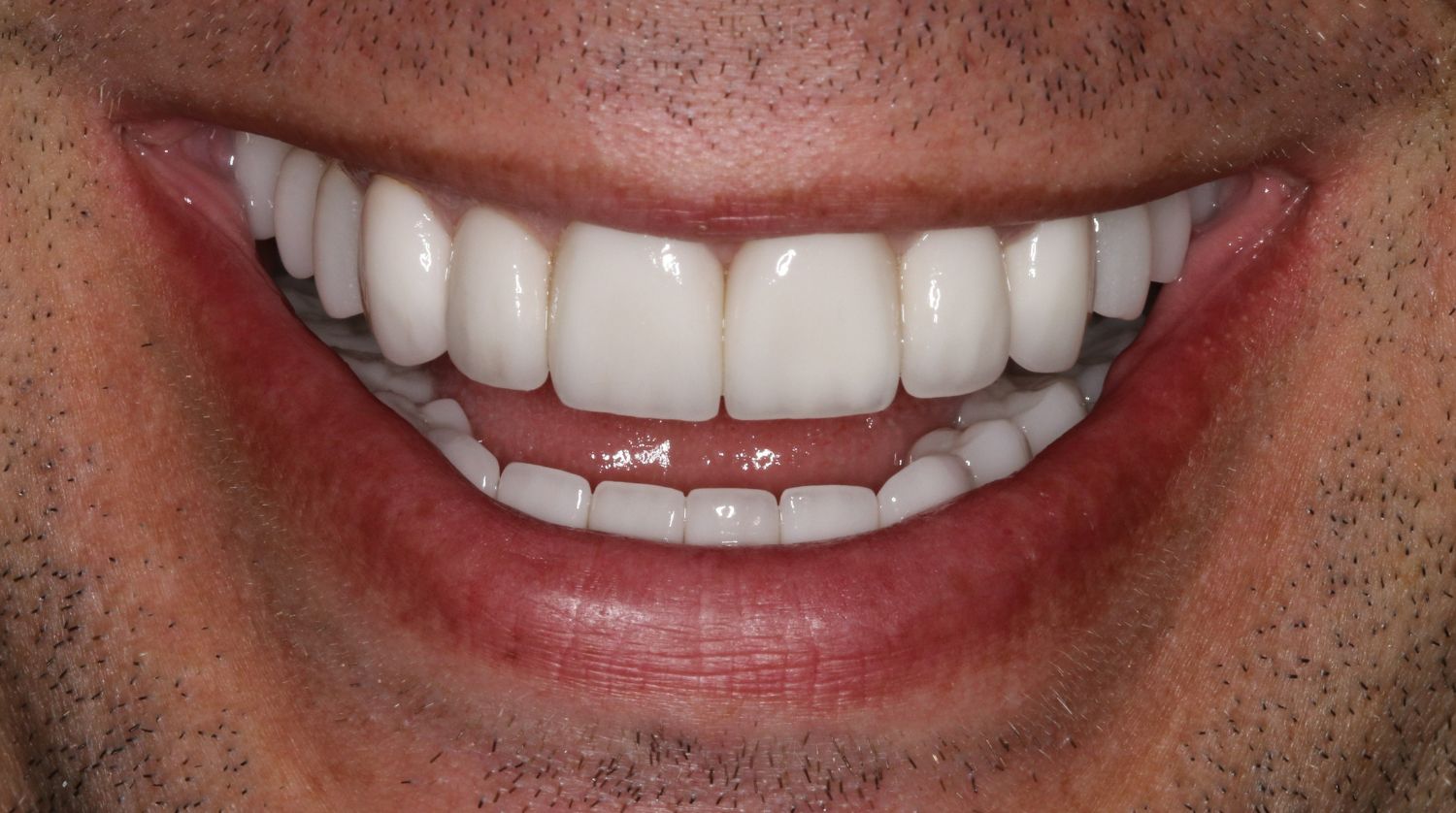 A close-up of a smile showing straight, bright white teeth framed by clean-shaven skin and natural lips.