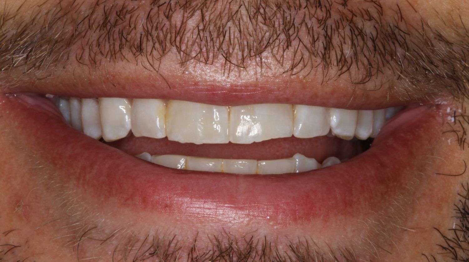 A close-up of a smile showing slightly discolored teeth with minor gaps, framed by a mustache and natural lips.