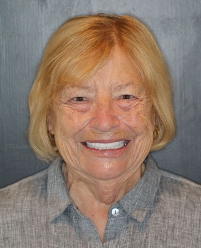 female dental patient after new All-on-4